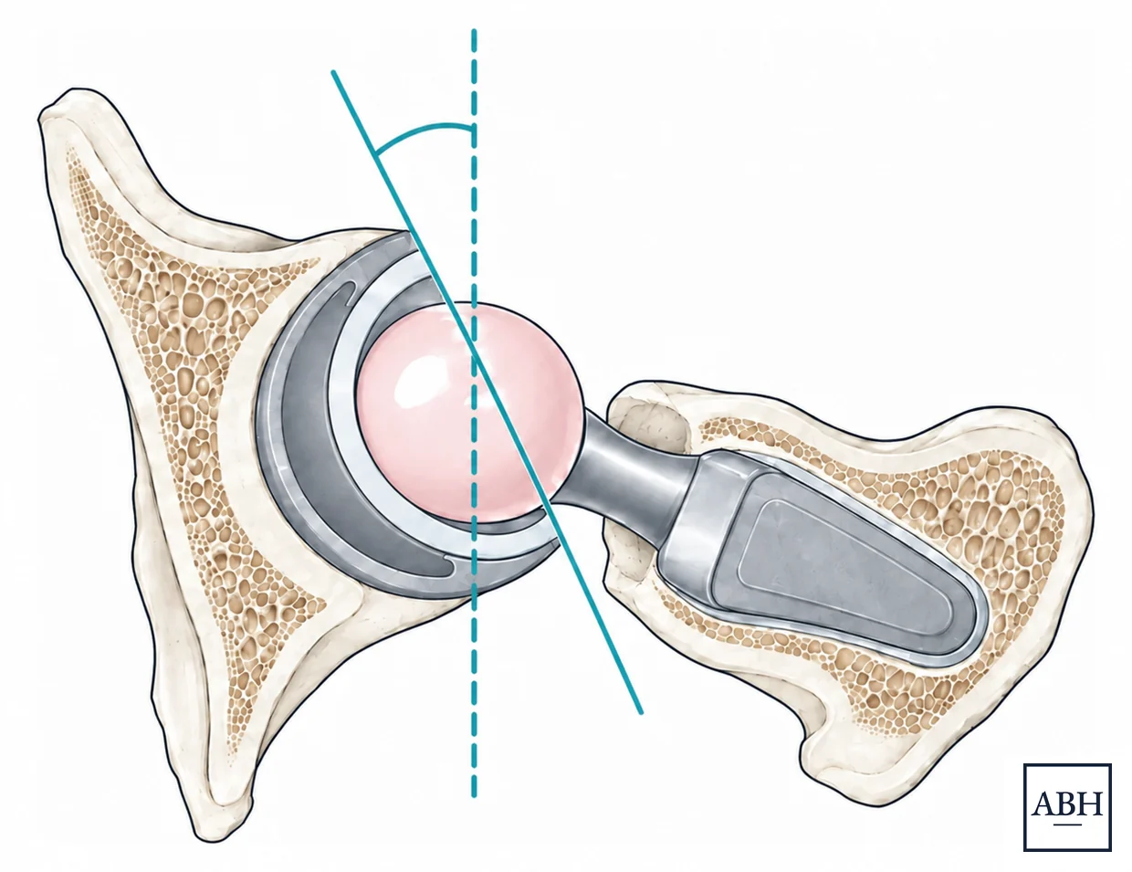 Cross-section through the hip seen from above, showing the socket component seated in the pelvis and the stem in the femur. A line across the face of the socket meets a vertical dashed line, marking the anteversion angle.