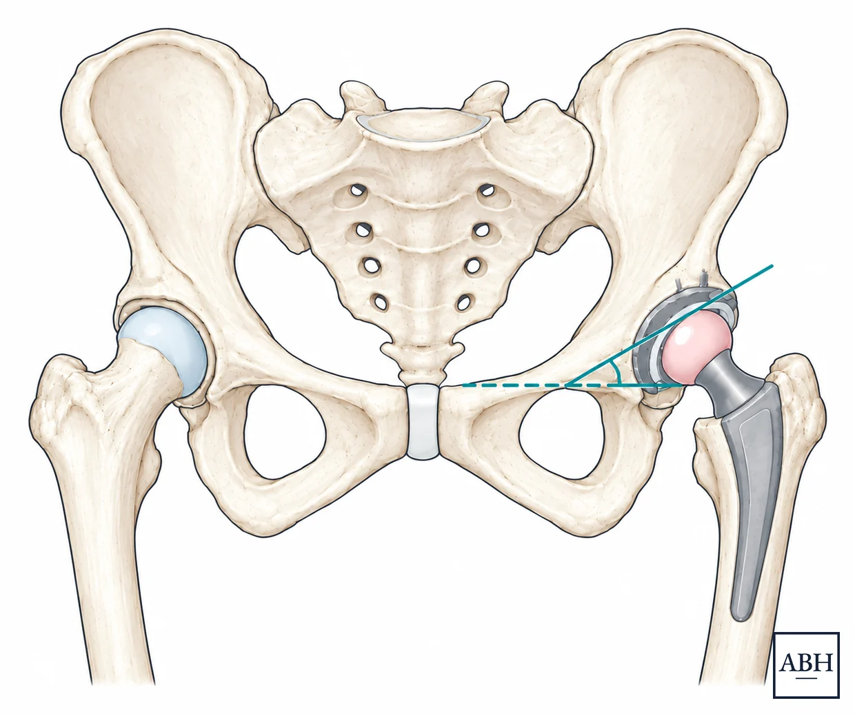 Front view of the pelvis with a hip replacement on the right of the image. A line along the face of the socket component meets a horizontal dashed line across the pelvis, marking the inclination angle.