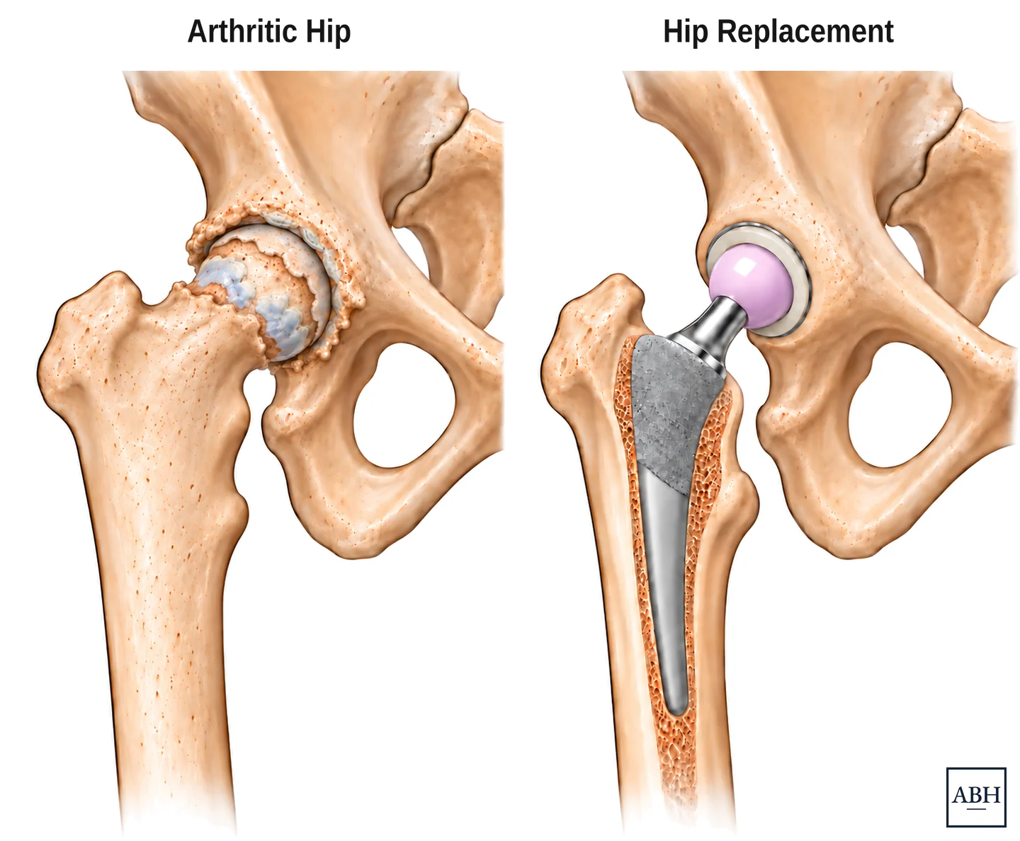 Two drawings of the same hip side by side. On the left an arthritic hip, with the cartilage worn down and extra bone built up around the edges of the ball and the socket. On the right the hip after joint replacement, with a stem set into the femur, a new head on top of it, and a liner and cup in the socket.