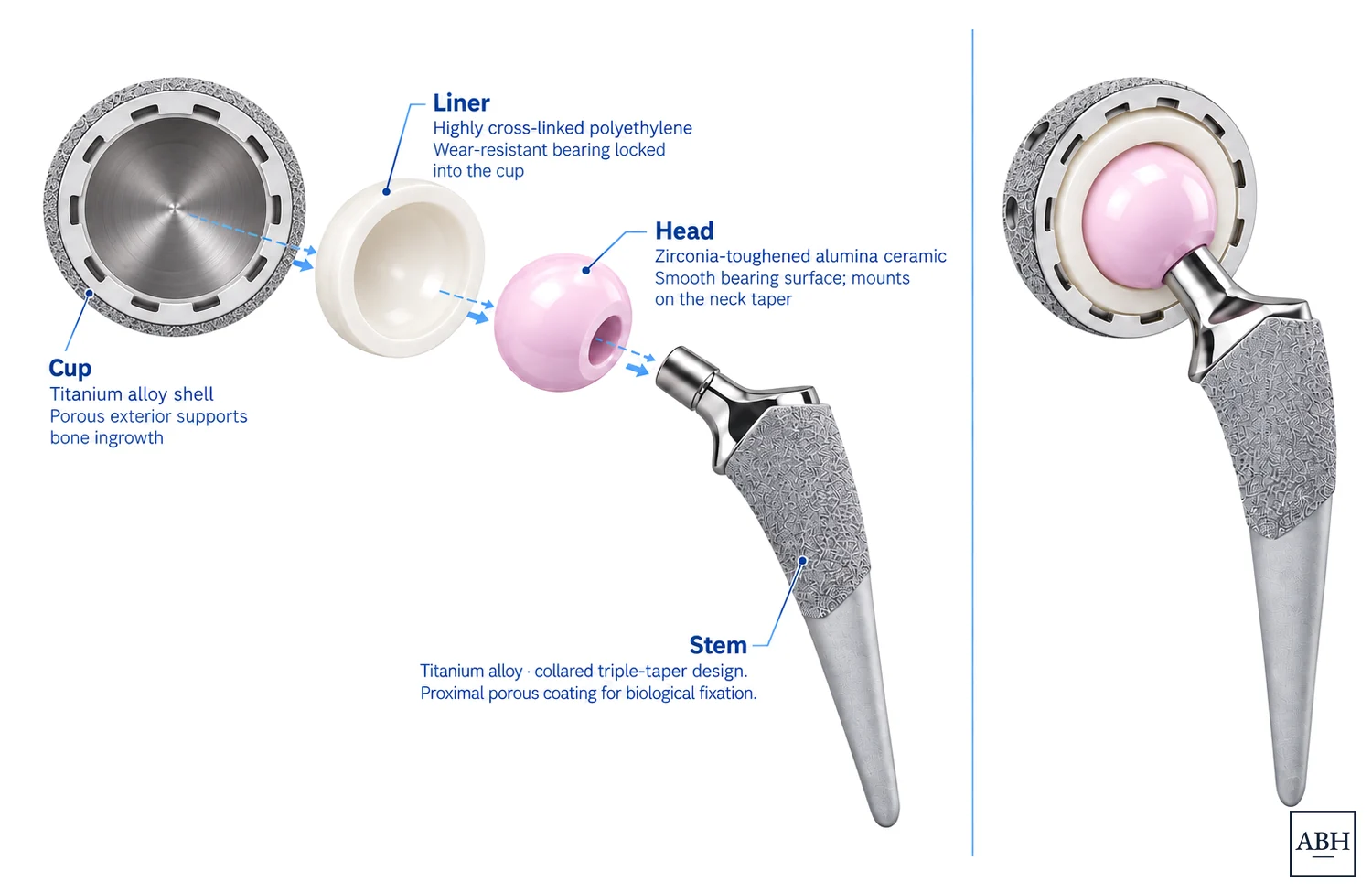 Diagram of the four parts of a hip replacement. On the left they are separated and labeled: a cup with a porous outer surface, a pale liner that locks into the cup, a rounded ceramic head, and a stem with a porous coated upper portion. On the right the same four parts are shown assembled, with the head seated in the liner inside the cup and the stem below it.