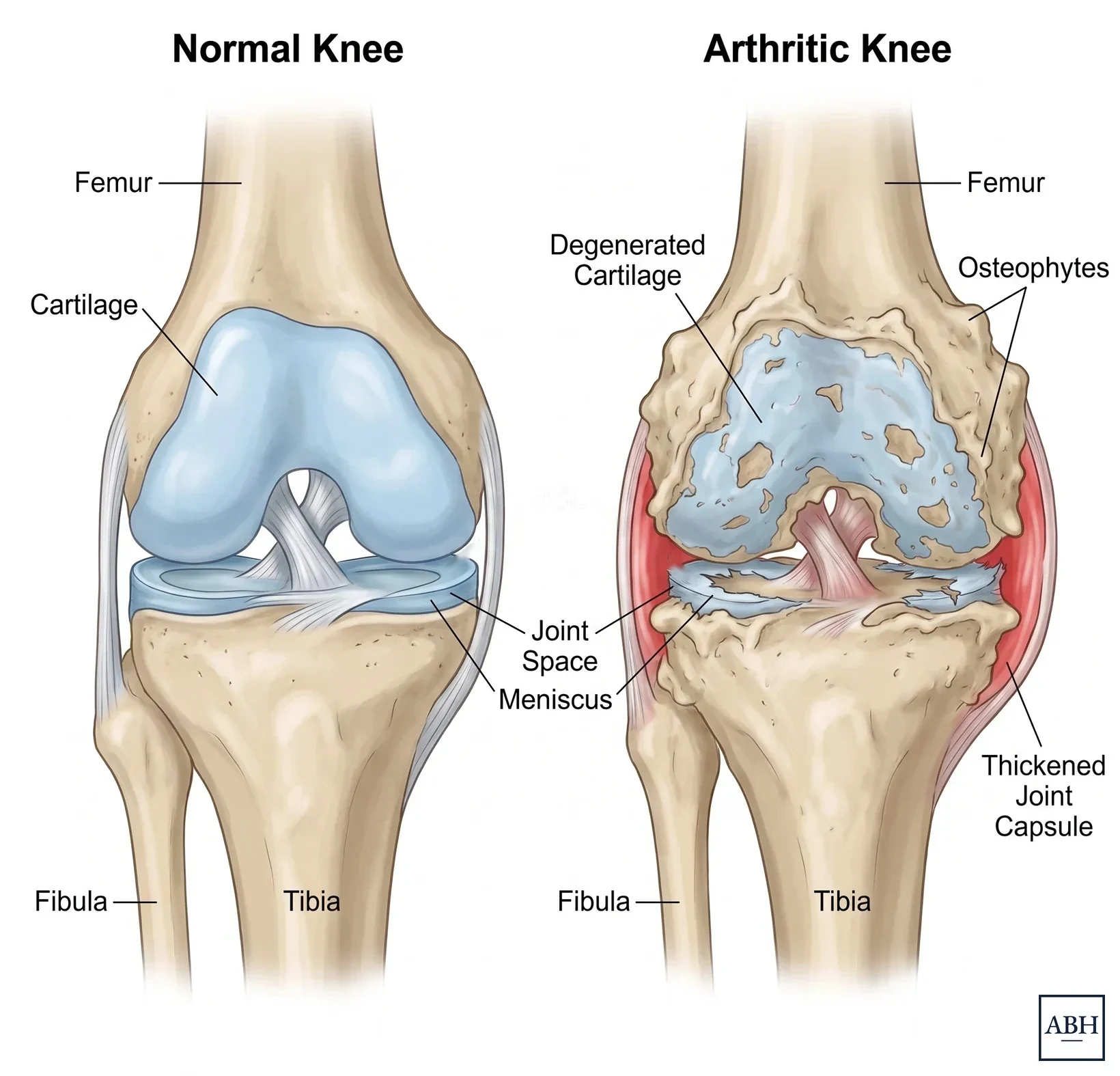 Anatomical comparison of a normal knee and an arthritic knee, showing smooth cartilage, an intact meniscus, and a clear joint space on the left, and degenerated cartilage, a torn meniscus, osteophytes, and a thickened joint capsule on the right.