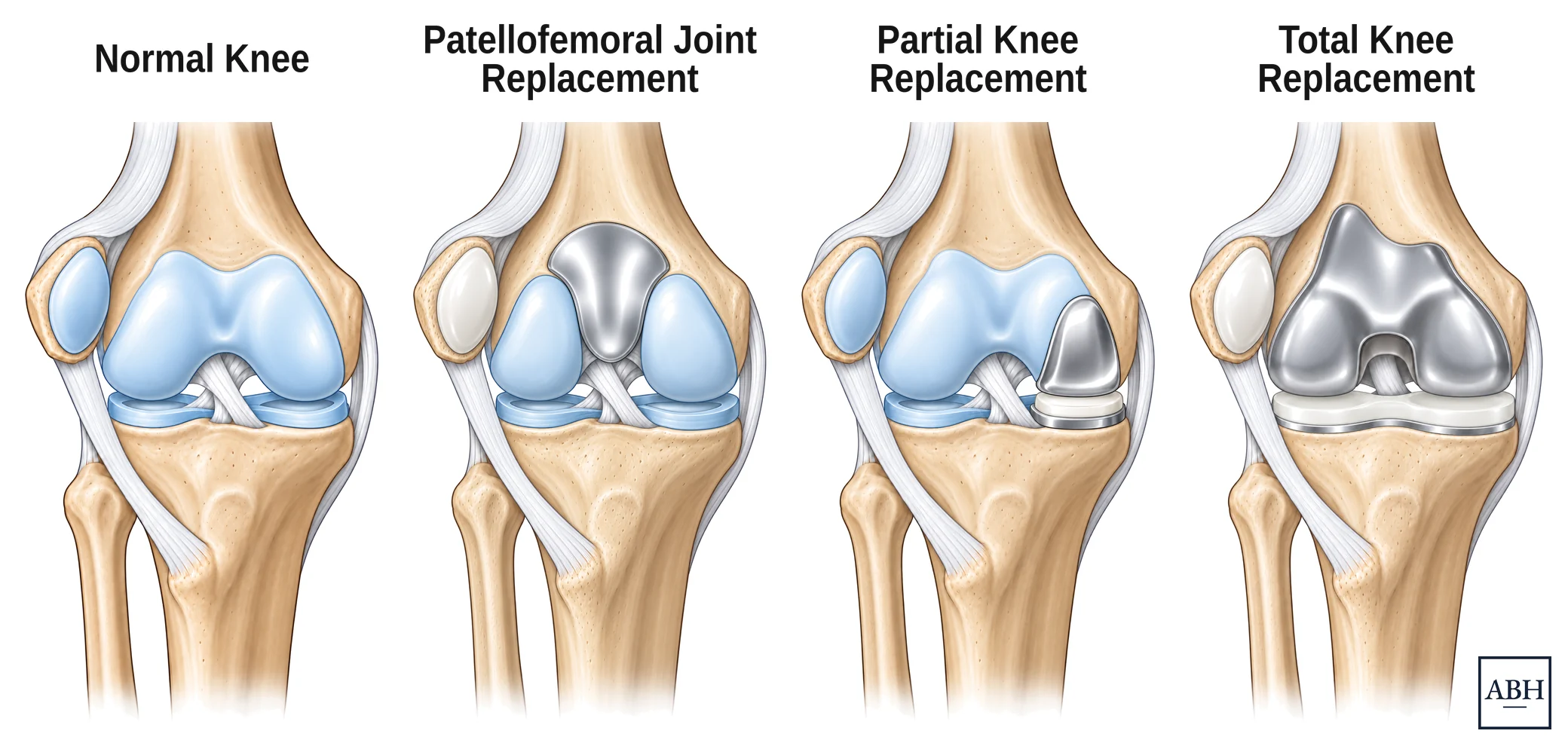 Four anatomical drawings of the same knee side by side. First a normal knee with cartilage on the groove at the front of the femur and on both sides of the joint between the femur and the tibia. Second a patellofemoral joint replacement, with a metal surface on the groove at the front of the femur only. Third a partial knee replacement, with a metal surface on one side of the joint between the femur and the tibia and a plastic bearing beneath it. Fourth a total knee replacement, with the end of the femur and the top of the tibia both resurfaced and a plastic bearing between them.