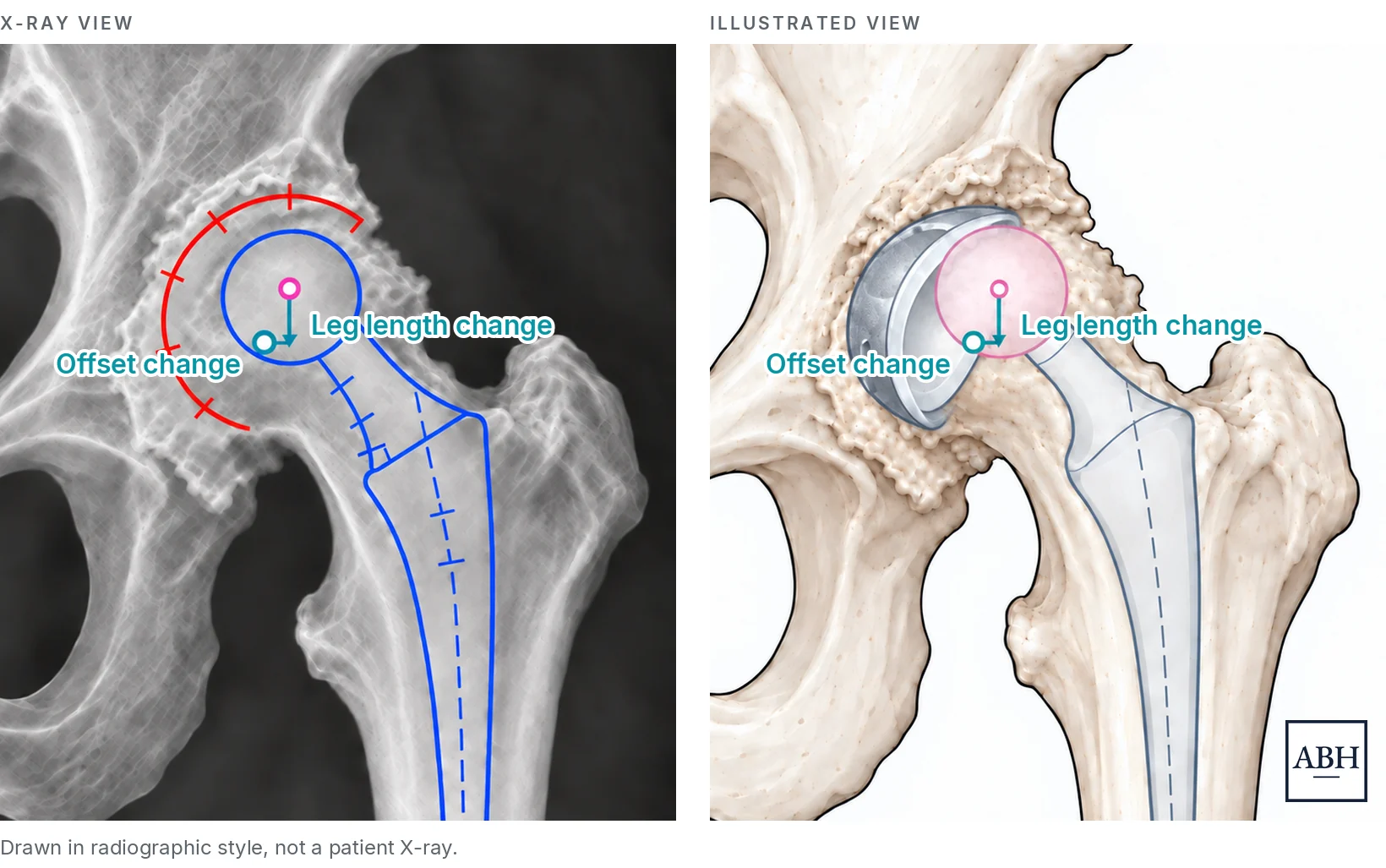 The same hip replacement plan shown two ways. On the left, an X-ray view with the planned cup and stem drawn over it. On the right, the same plan as an illustration. In both panels a pink marker sits at the center of the ball and a teal marker below and to its side, joined by a vertical arrow marked leg length change and a horizontal arrow marked offset change.