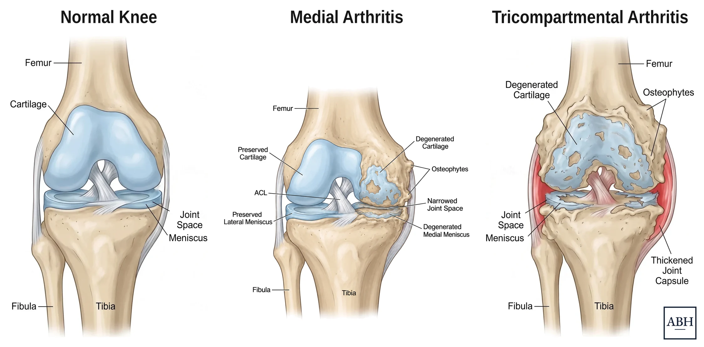 Three anatomical drawings of a knee side by side. On the left a normal knee with smooth cartilage throughout. In the middle arthritis limited to the inner compartment, with worn cartilage, a narrowed joint space, bone spurs and a degenerated medial meniscus on the inner side while the outer compartment and the ACL are preserved. On the right tricompartmental arthritis, with cartilage worn throughout, bone spurs, a torn meniscus and a thickened joint capsule.