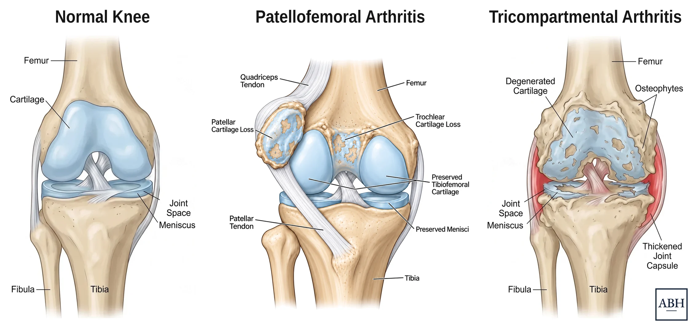 Three anatomical drawings of a knee side by side. On the left a normal knee with smooth cartilage throughout. In the middle patellofemoral arthritis, where the cartilage on the kneecap and in the groove at the front of the femur is worn away while the cartilage and menisci between the femur and tibia are preserved. On the right tricompartmental arthritis, with cartilage worn throughout, bone spurs, a torn meniscus and a thickened joint capsule.