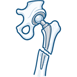 Illustration of a hip replacement with a fracture in the femur below it