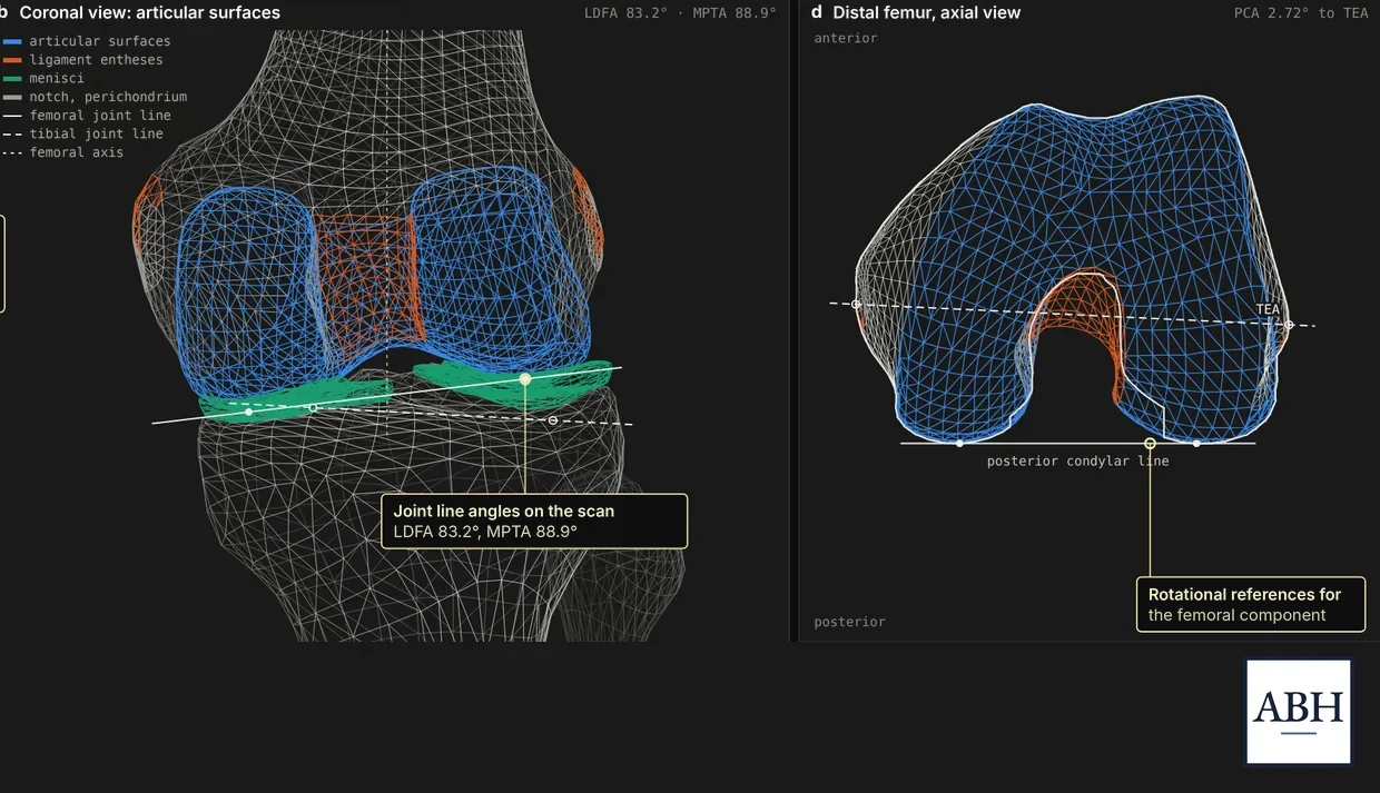 The scanned knee as a 3D mesh, from the front with its joint surfaces and ligament attachments, and the end of the femur with its rotational reference lines