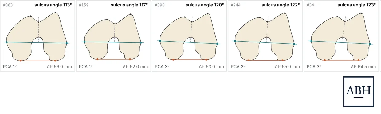 Five distal femurs viewed end on, each with a different trochlear groove angle, posterior condylar angle and size