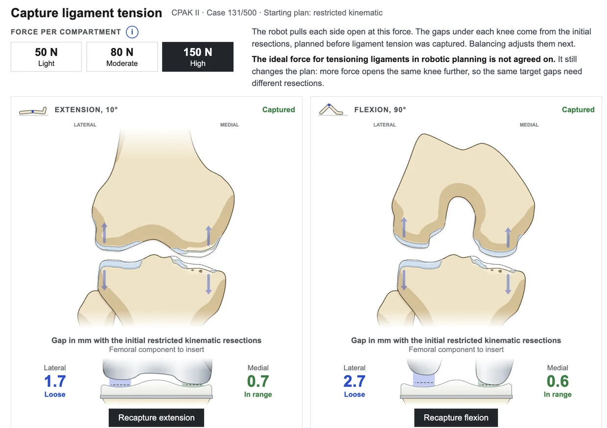 The ligament tension screen, with a choice of distraction force and the medial and lateral gaps captured in extension and in flexion
