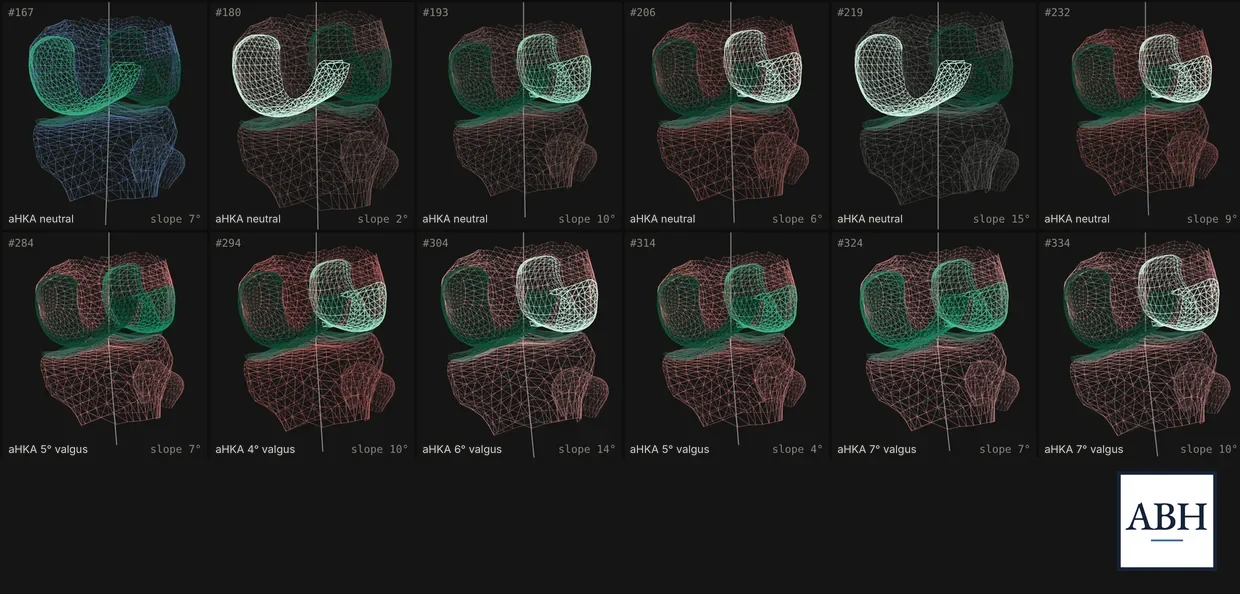 Twelve simulated knees shown as 3D meshes, with cartilage shaded from intact to worn away and bone tinted by alignment